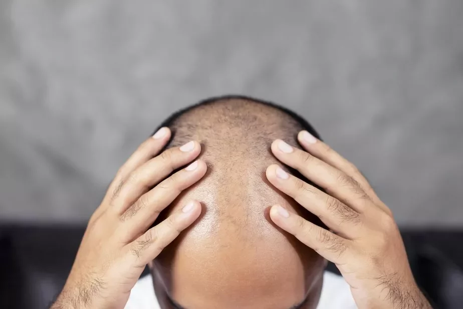 ałapiecyja ałopiecija alopecia